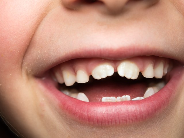 Knocked-Out Teeth