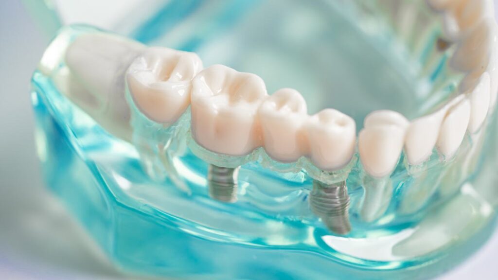 Dental Anxiety